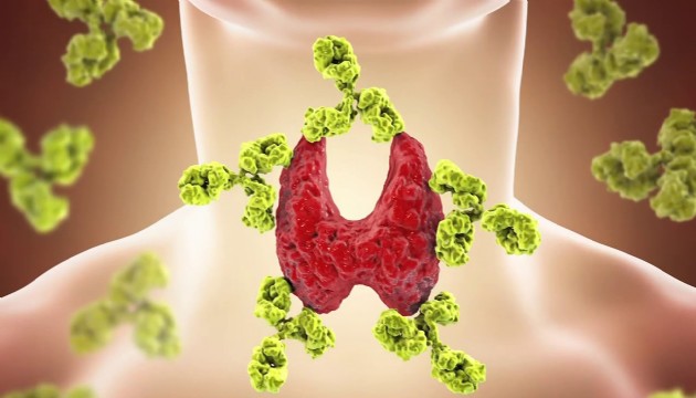 Uzman uyardı: Yorgunluk ve kilo artışı Hashimoto belirtisi olabilir